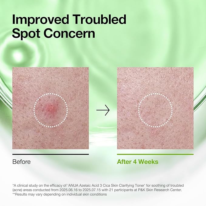 Anua Azelaic Acid 3 Cica Skin Clarifying Toner - Olive Kollection