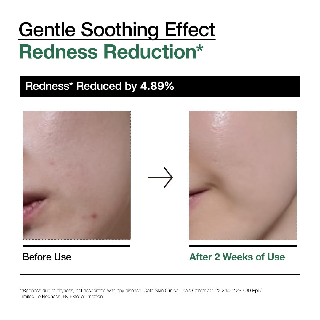 Anua Heartleaf Ampoule on skin – calms acne inflammation soothes redness glowing skin Korean serum