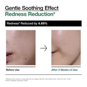 Anua Heartleaf Ampoule on skin – calms acne inflammation soothes redness glowing skin Korean serum