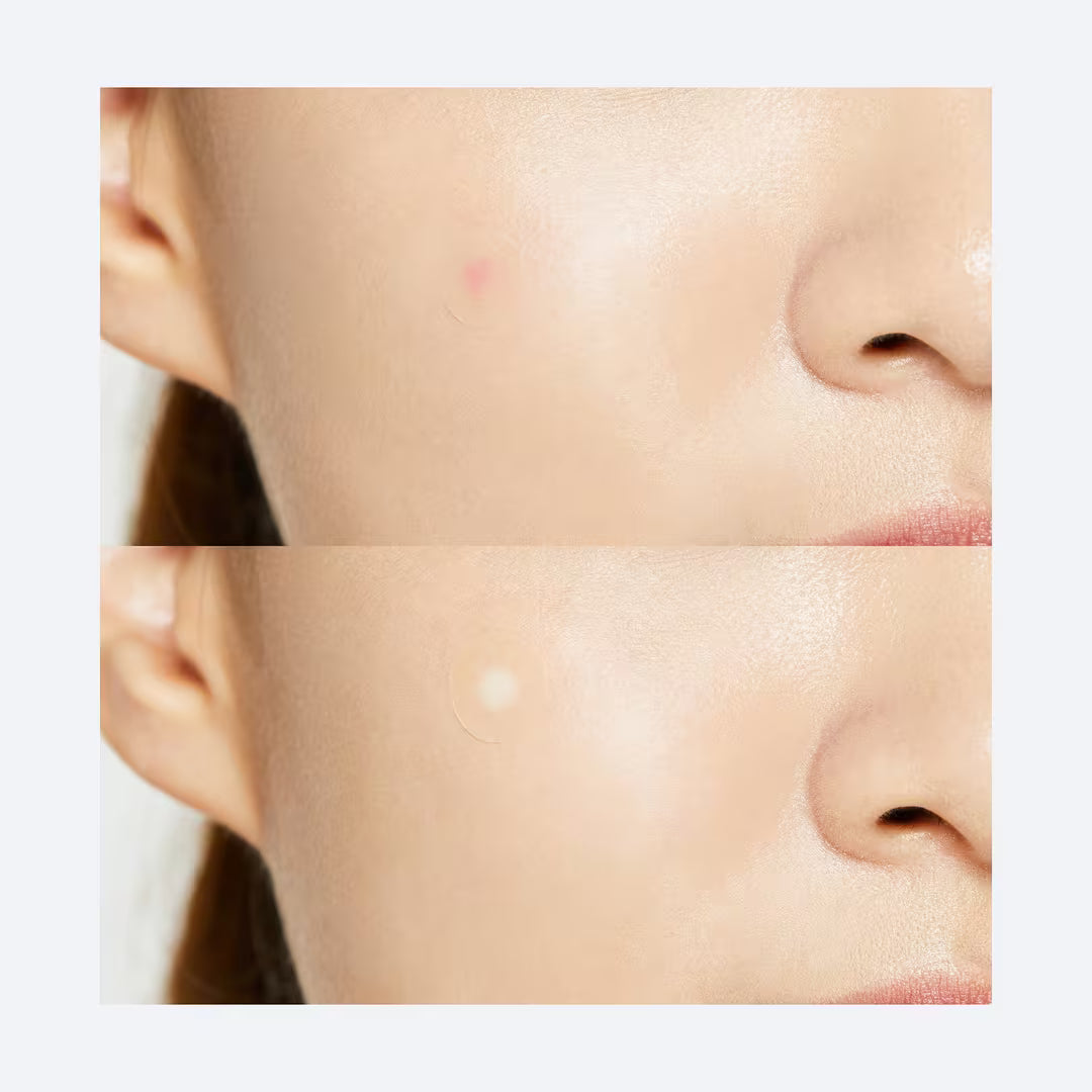 COSRX Acne Master Patch results – flatter calmer blemish 338 reviews 4.8 stars Korean pimple patch Olive Kollection