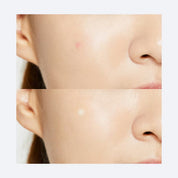 COSRX Acne Master Patch results – flatter calmer blemish 338 reviews 4.8 stars Korean pimple patch Olive Kollection