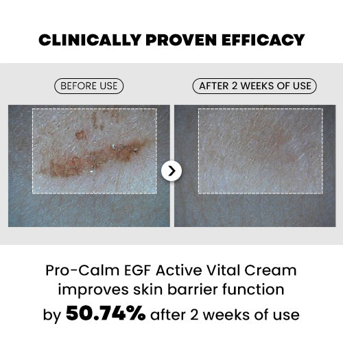 PRO-CALM EGF Active Cream texture – lightweight pharmacy-grade barrier repair sensitive post-treatment skin 20ml